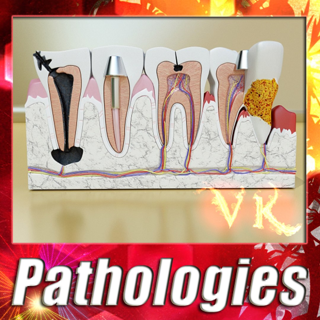 Teeth Pathologies - Tooth 3d 3ds