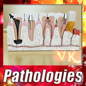 Tooth Pathologies - High Detailed