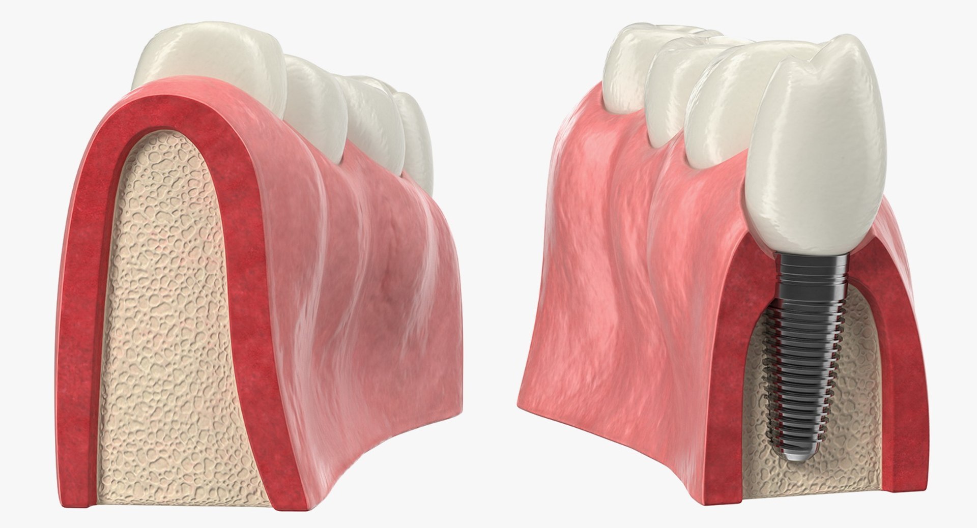 Tooth Implants Collection 2 3D model https://p.turbosquid.com/ts-thumb/4x/50dBRt/Cx/toothimplantscollection23dsmodel041/jpg/1698620486/1920x1080/fit_q87/51bbdfbc92a7cc84486ac1230102af015880eaed/toothimplantscollection23dsmodel041.jpg