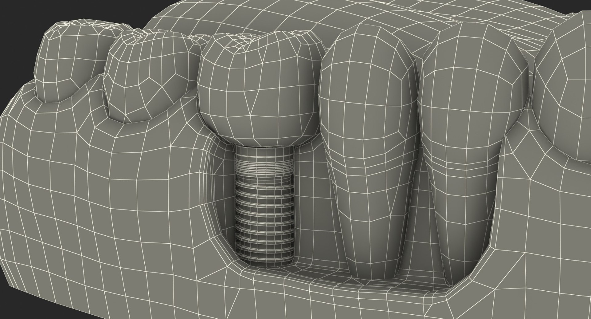 Tooth Implants Collection 2 3D model https://p.turbosquid.com/ts-thumb/4x/50dBRt/Io/toothimplantscollection23dsmodel087/jpg/1698620664/1920x1080/fit_q87/2208c38d857d23606632bf52f9e0ec2db23bb942/toothimplantscollection23dsmodel087.jpg