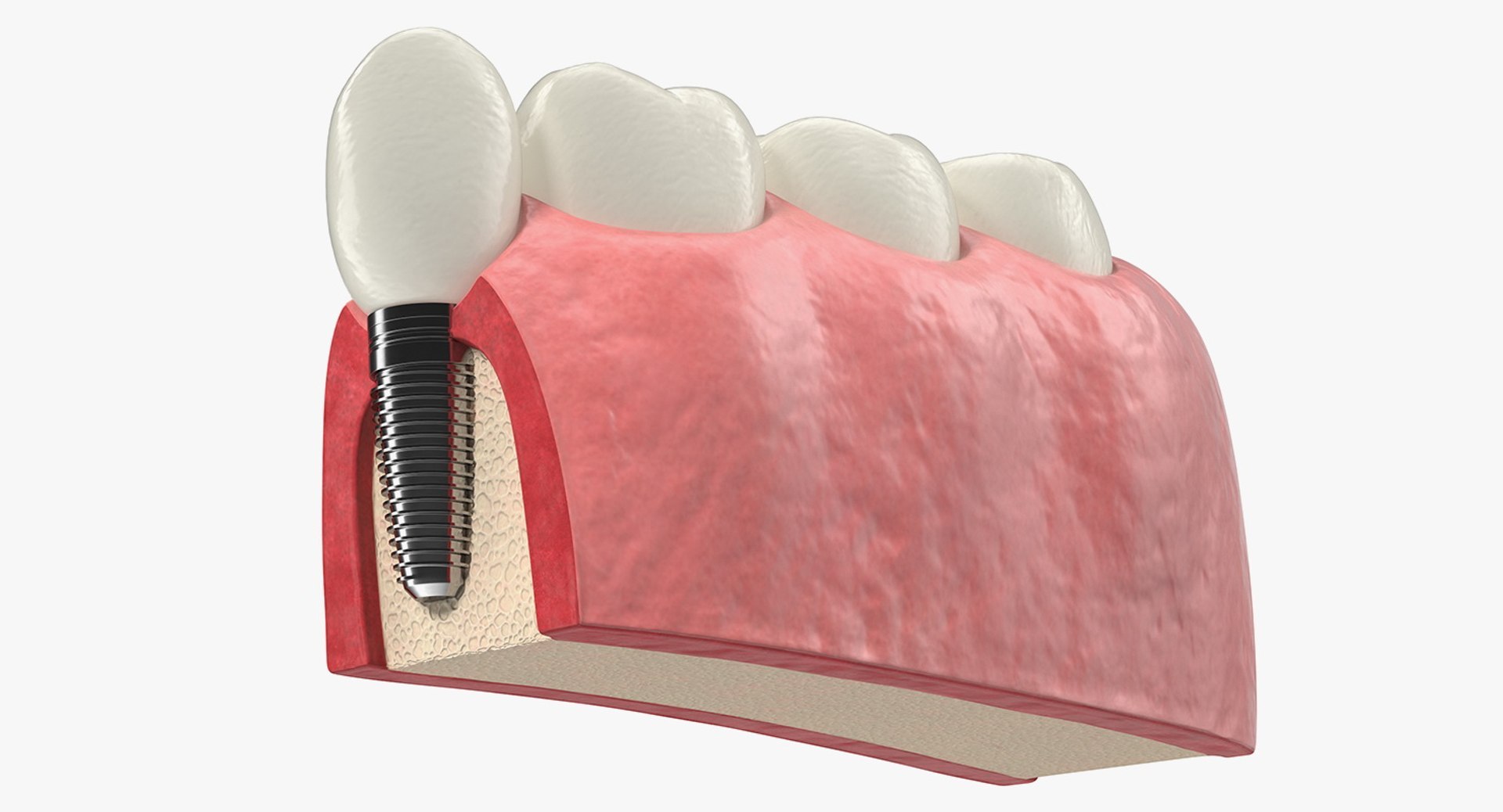 Tooth Implants Collection 2 3D model https://p.turbosquid.com/ts-thumb/4x/50dBRt/Qu/toothimplantscollection23dsmodel039/jpg/1698620478/1920x1080/fit_q87/e26e180bce08427554eb86b0dbde4d5e3ab9fbb4/toothimplantscollection23dsmodel039.jpg
