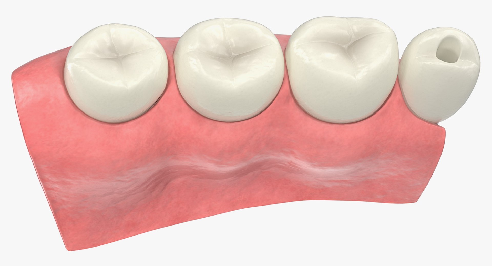 Tooth Implants Collection 2 3D model https://p.turbosquid.com/ts-thumb/4x/50dBRt/bL/toothimplantscollection23dsmodel040/jpg/1698620482/1920x1080/fit_q87/0d728c7d374e40c2a798ad5d47beb0c74ae49e3b/toothimplantscollection23dsmodel040.jpg