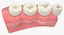 Colección de implantes dentales 2