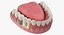 Colección de implantes dentales 2