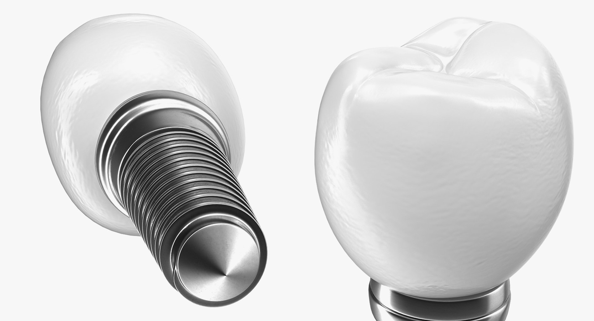 Tooth Implants Collection 2 3D model https://p.turbosquid.com/ts-thumb/4x/50dBRt/ld/toothimplantscollection23dsmodel055/jpg/1698620540/1920x1080/fit_q87/6e781ff29f70d807bdd4e9c19d4fc60f63b4b16f/toothimplantscollection23dsmodel055.jpg