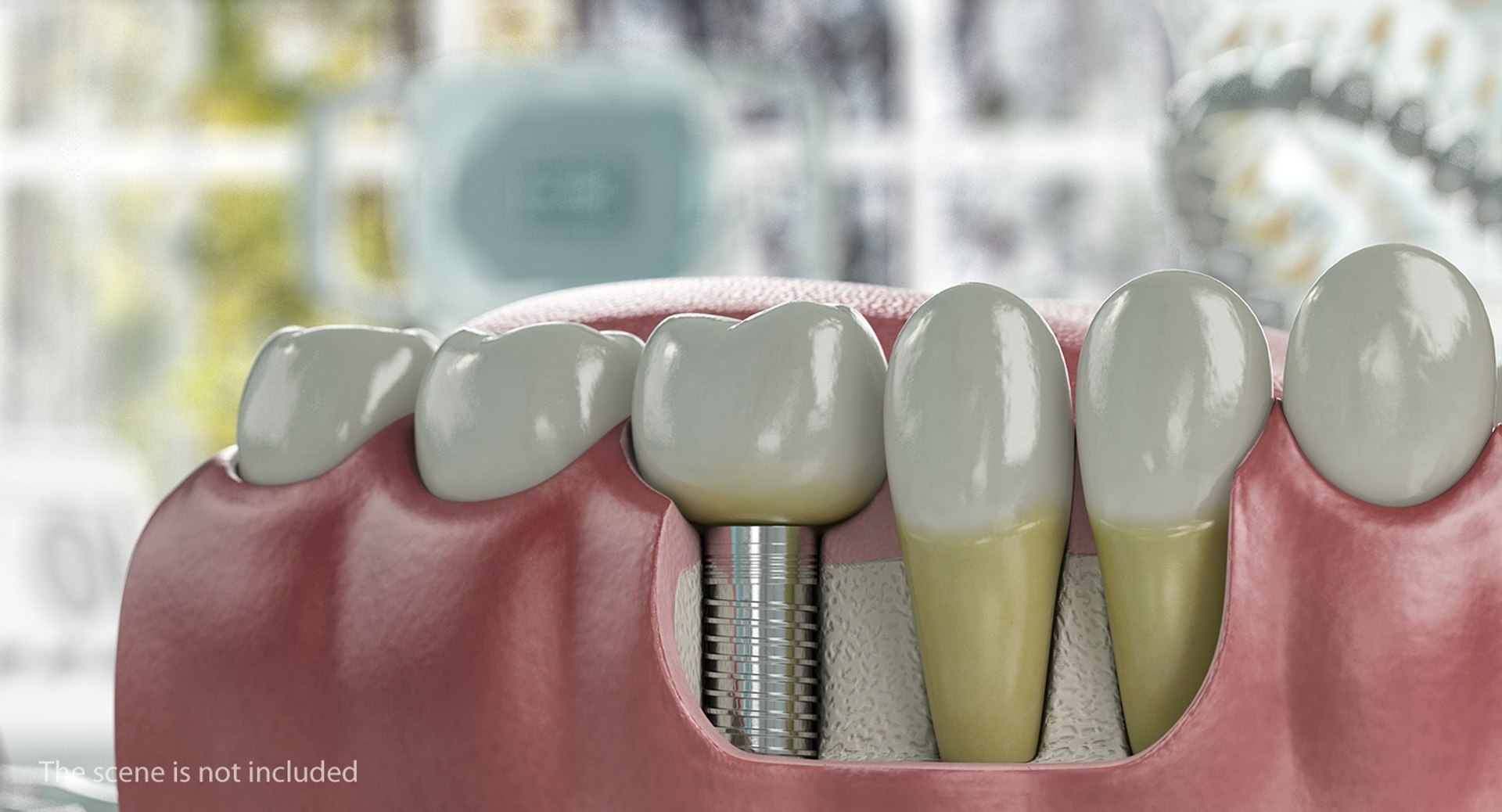 Tooth Implants Collection 2 3D model https://p.turbosquid.com/ts-thumb/4x/50dBRt/mb/toothimplantscollection23dsmodel060/jpg/1698620559/1920x1080/fit_q87/bfa912e599dce82ce4c6a674672aefceaebbefbc/toothimplantscollection23dsmodel060.jpg