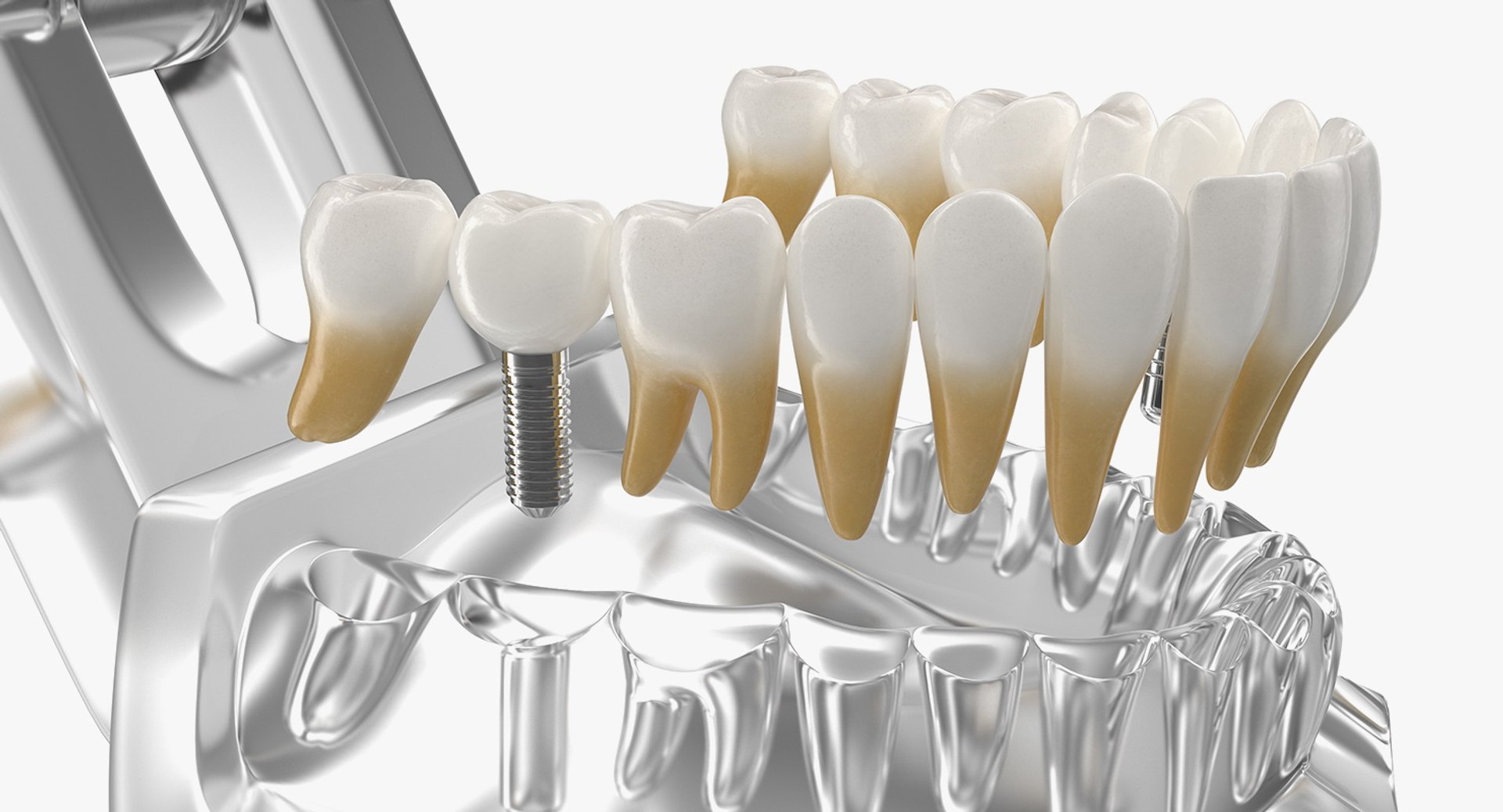 Tooth Implants Collection 2 3D model https://p.turbosquid.com/ts-thumb/4x/50dBRt/nL/toothimplantscollection23dsmodel076/jpg/1698620620/1920x1080/fit_q87/e19216e8ddb0fb6891e89914b22a19faf9fa4e0c/toothimplantscollection23dsmodel076.jpg