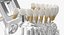 Colección de implantes dentales 2
