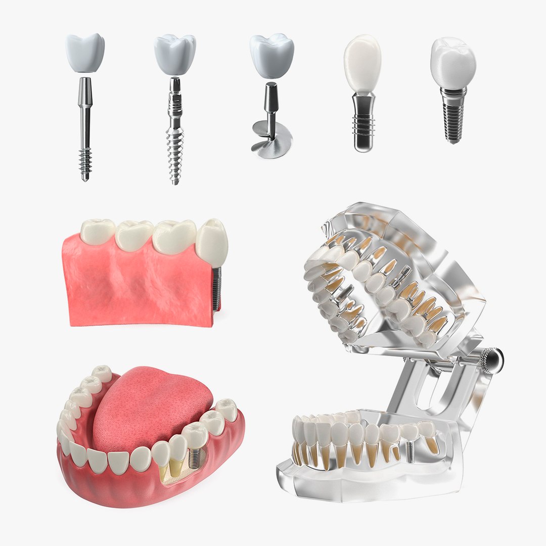Tooth Implants Collection 2 3D model preview