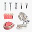 Colección de implantes dentales 2
