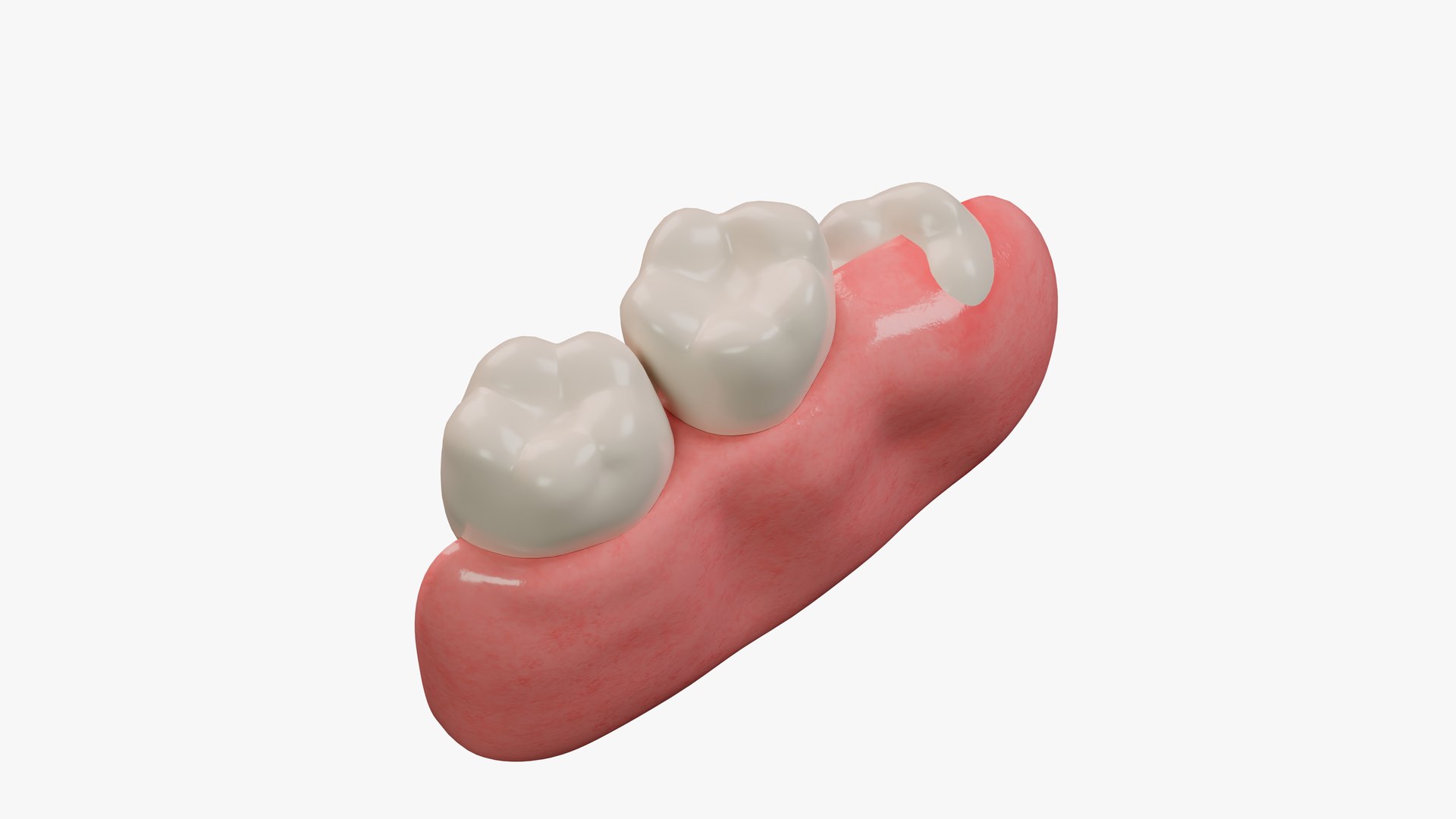 Impacted Wisdom Teeth Incision Model - TurboSquid 1866827