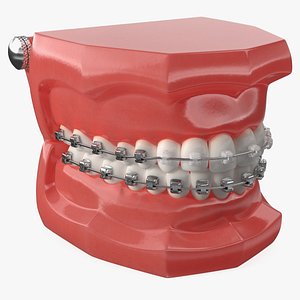 Ligature-Free Braces on Artificial Jaw