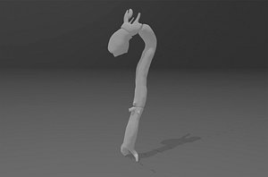 Real aortic dissection 3D model