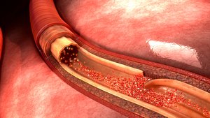 Artery dissection Animated