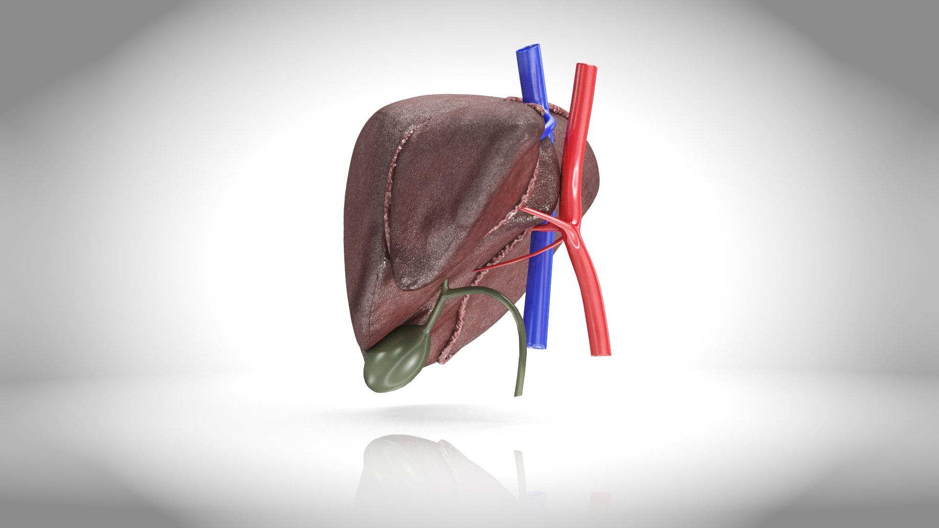 3D Fatty Liver Steatosis - TurboSquid 2132775
