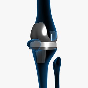 artificial knee replacement 3d model