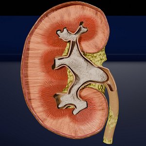Kidney stone nephrolithiasis Staghorn calculus 3D model