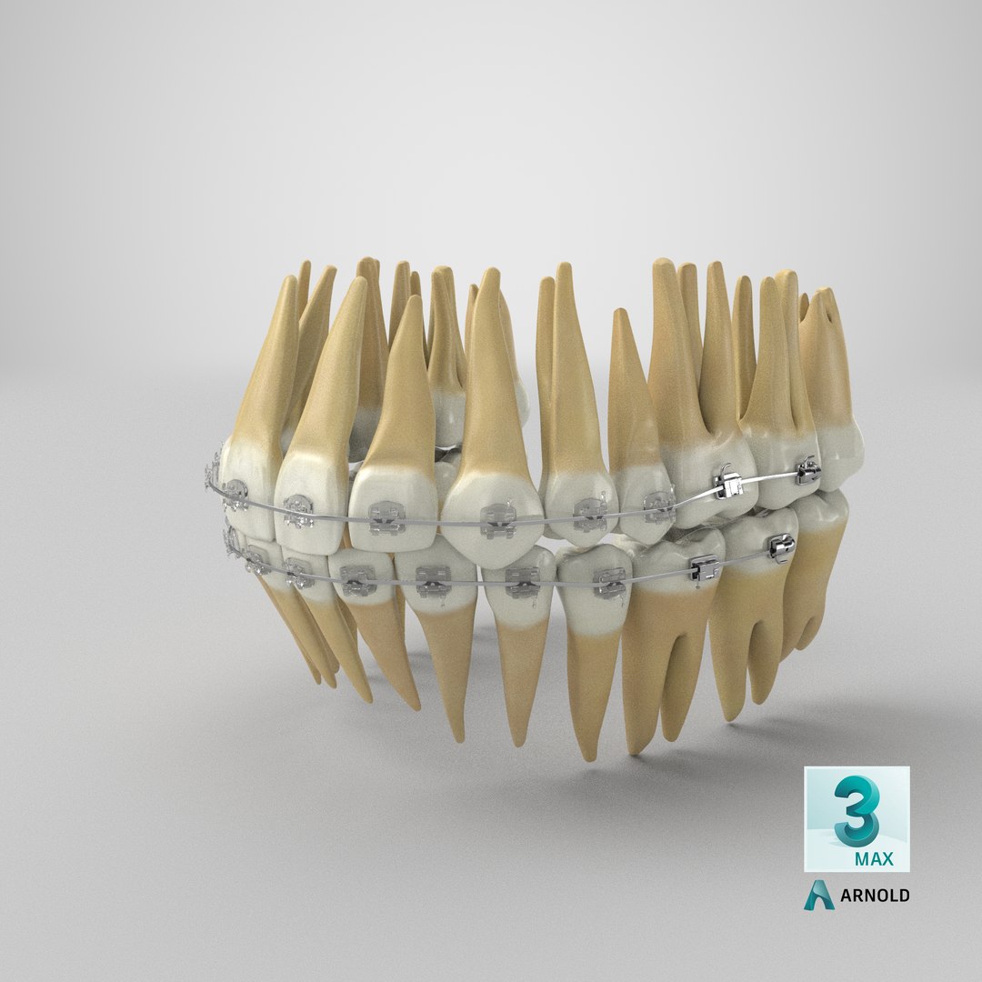 3D Human Teeth With Self Ligating Transparent Dental Braces V01 model https://p.turbosquid.com/ts-thumb/6S/lOxmjB/KH/stemcell_max_arnold_render/png/1701842520/1920x1080/fit_q87/be2d195141eb185cc87010a12d96184935fef142/stemcell_max_arnold_render.jpg
