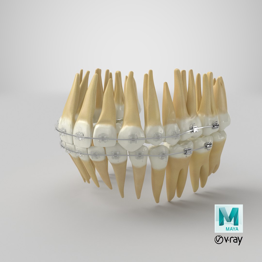 3D Human Teeth With Self Ligating Transparent Dental Braces V01 model https://p.turbosquid.com/ts-thumb/6S/lOxmjB/LL/stemcell_maya_vray_render/png/1701842513/1920x1080/fit_q87/0d9358709fb9c91adc777e04a272359c3429faff/stemcell_maya_vray_render.jpg