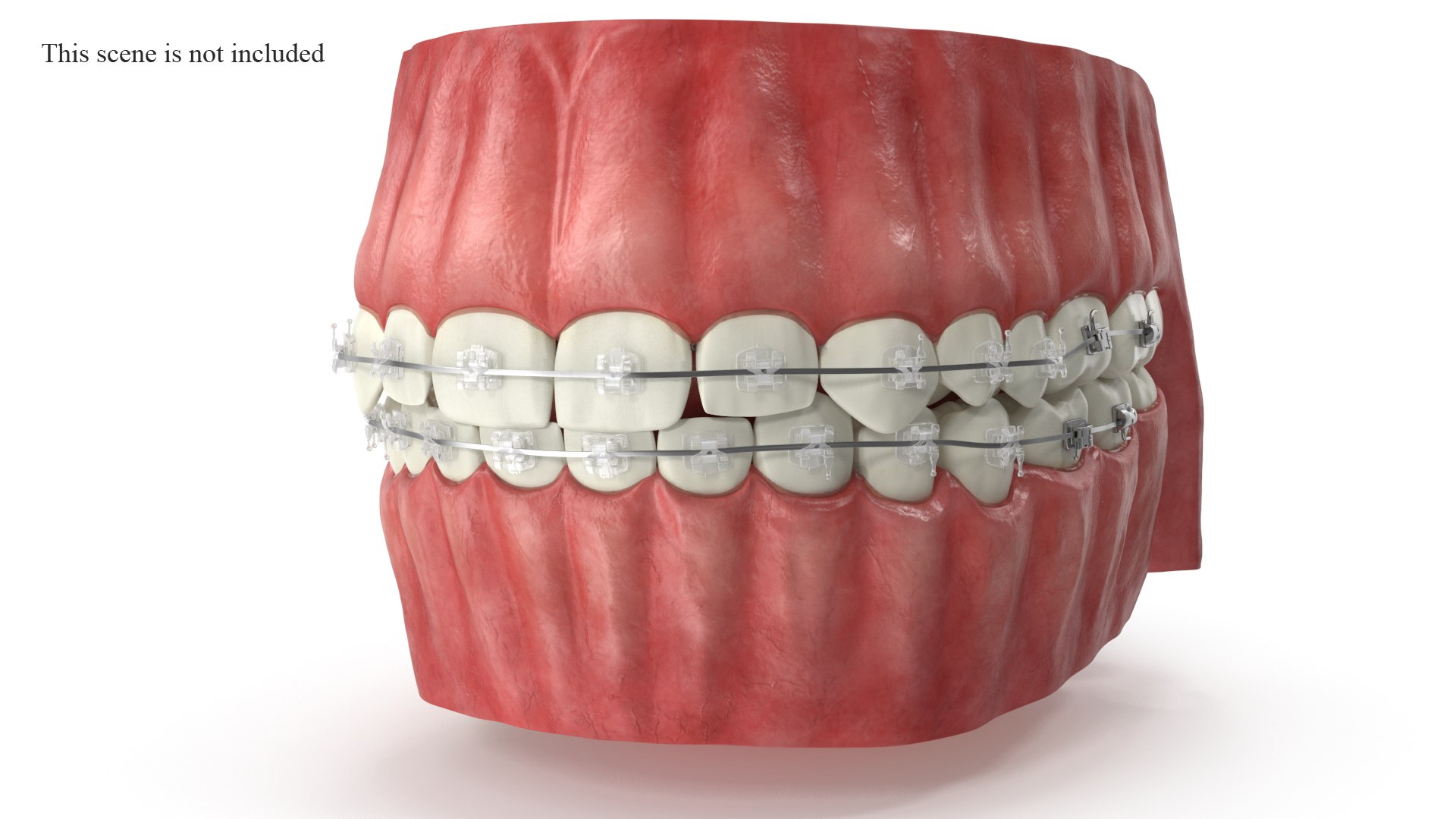 3D Human Teeth With Self Ligating Transparent Dental Braces V01 model https://p.turbosquid.com/ts-thumb/6S/lOxmjB/Xb/selfligatingtransparentdentalbraces_presentation/jpg/1699210156/1920x1080/fit_q87/45b0b019c86eb286d6ef81e35af3e2b025c1712b/selfligatingtransparentdentalbraces_presentation.jpg