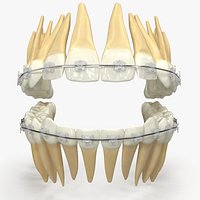 Human Teeth With Self Ligating Transparent Dental Braces V01