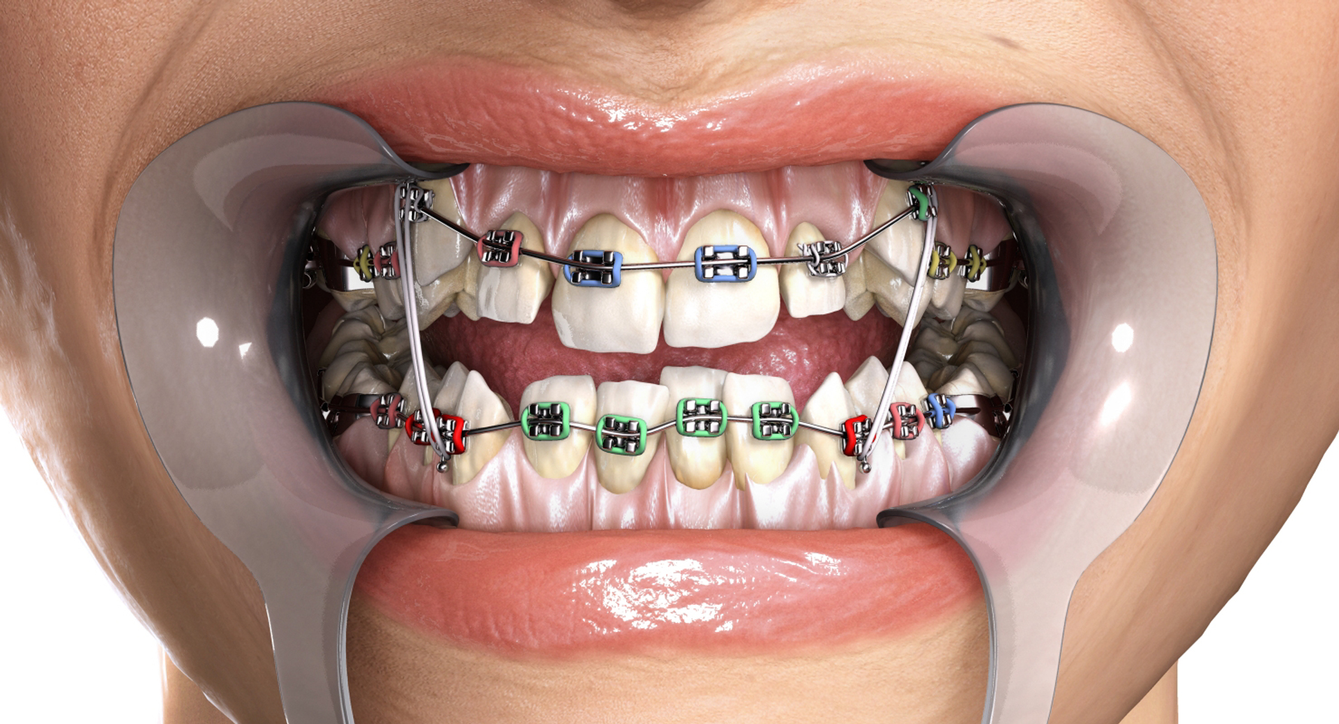 mouth orthodontics dental v4 max https://p.turbosquid.com/ts-thumb/6a/EwjCaR/64dPFxNz/crowdingwide/jpg/1458827300/1920x1080/turn_fit_q99/b6e74b1ed8eefd85a3a5079a7054f6f8e591dbb0/crowdingwide-1.jpg