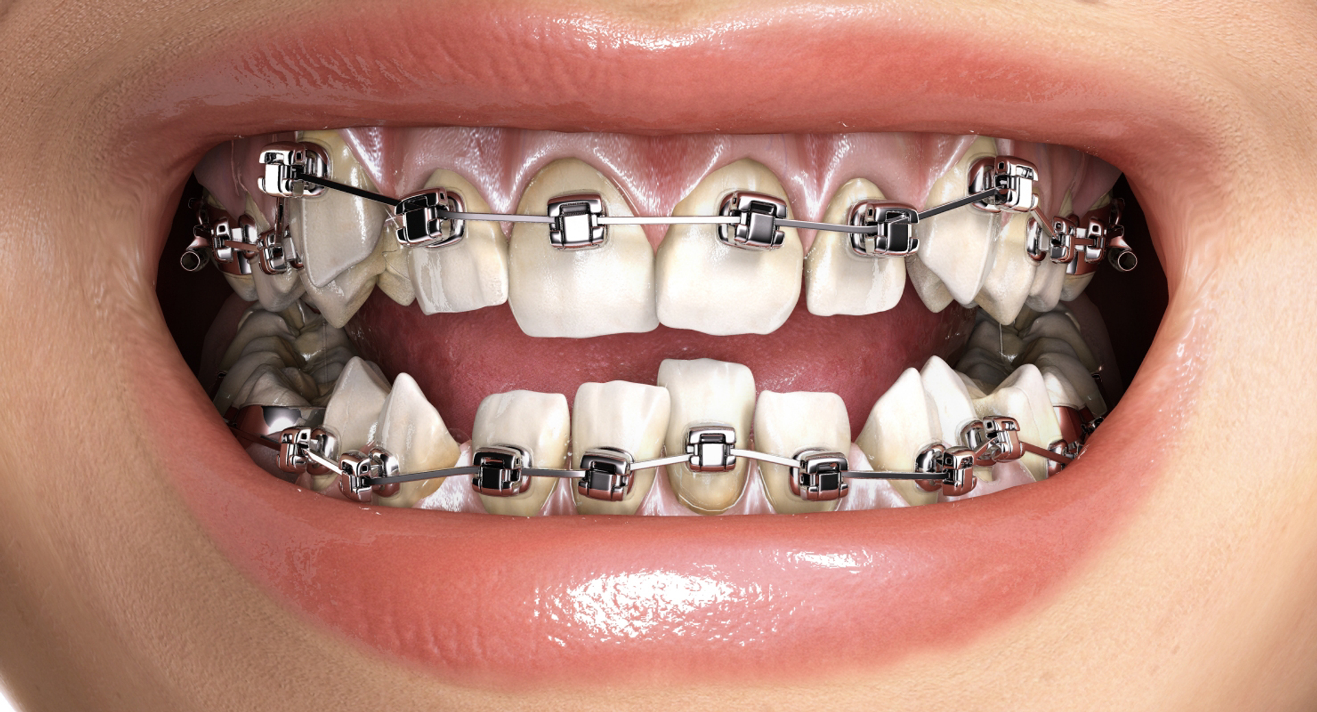 mouth orthodontics dental v4 max https://p.turbosquid.com/ts-thumb/6a/EwjCaR/7jh4xZpM/crowdingdamon/jpg/1458860310/1920x1080/turn_fit_q99/a002833e7be2a454964b4761b1dcde844edb6a69/crowdingdamon-1.jpg