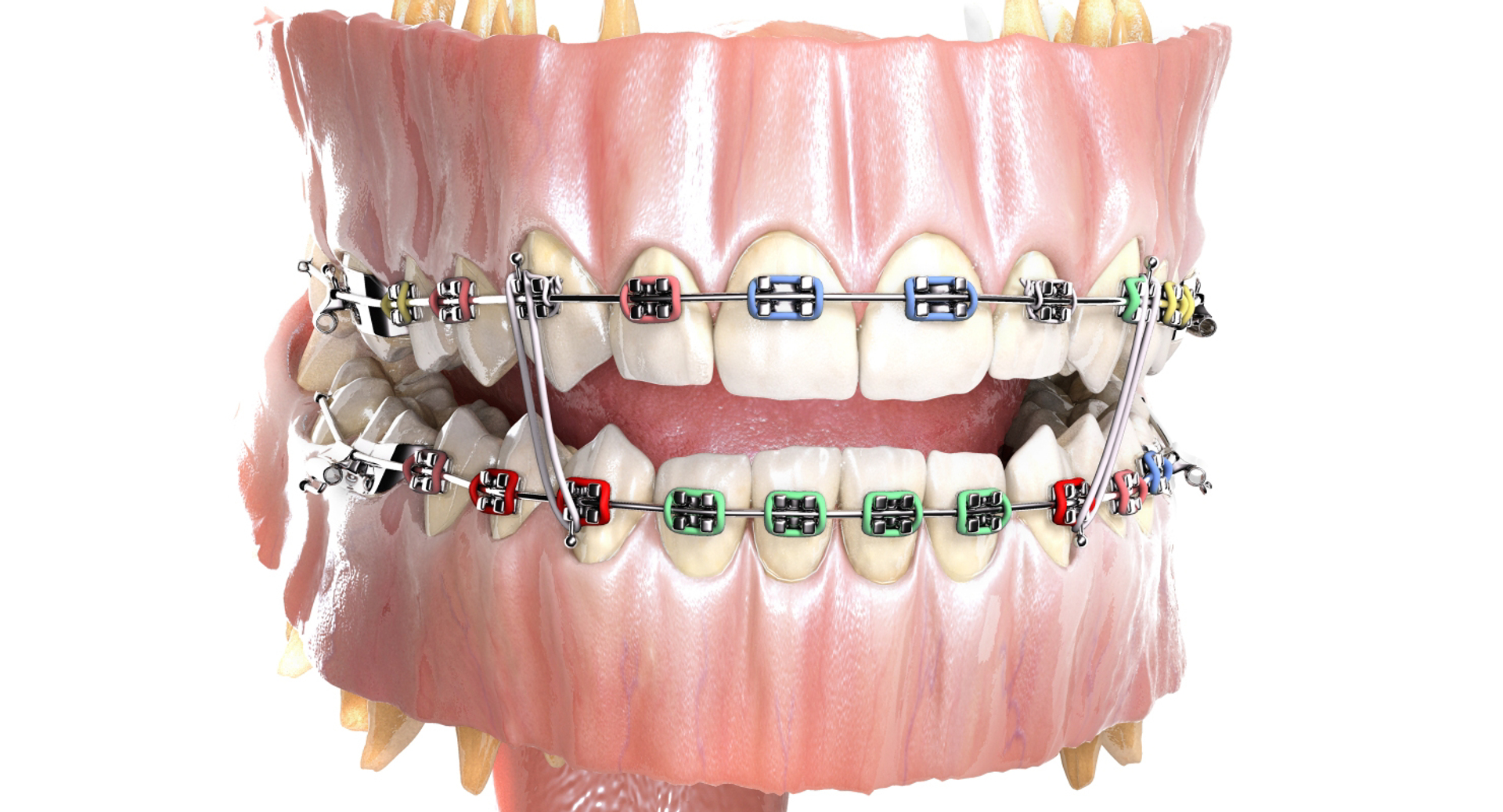 mouth orthodontics dental v4 max https://p.turbosquid.com/ts-thumb/6a/EwjCaR/pd7tjdul/mouthbraces/jpg/1459120225/1920x1080/turn_fit_q99/254bc631a239b09d89fc9256cb6787b1276e7014/mouthbraces-1.jpg
