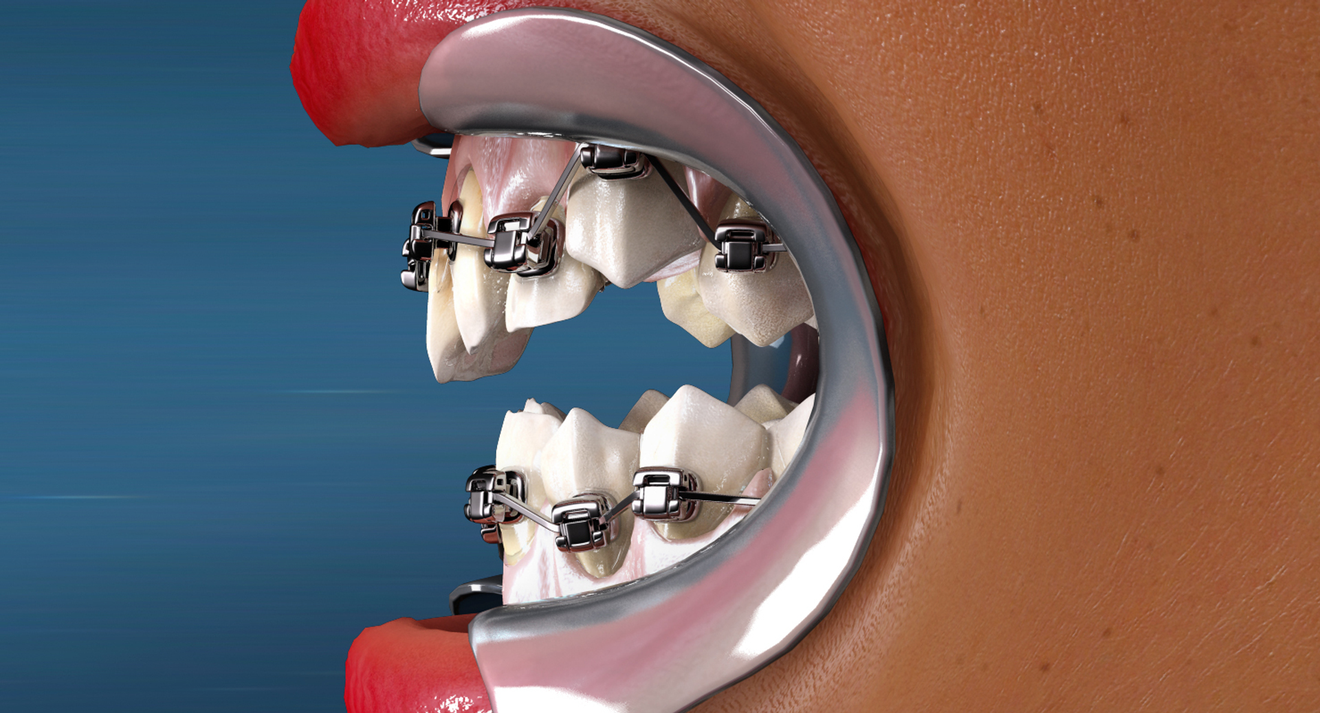 mouth orthodontics dental v4 max https://p.turbosquid.com/ts-thumb/6a/EwjCaR/qc8g7Svg/crowding/jpg/1458949051/1920x1080/turn_fit_q99/123b568095f24a5611bdfa1425a7588cbeb7960c/crowding-1.jpg