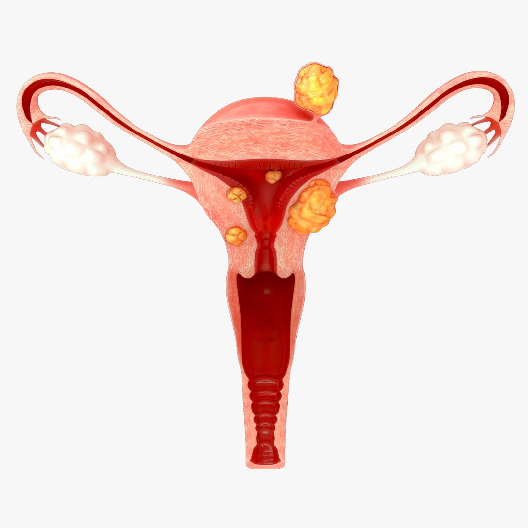 Uterine Fibroids 3D Model - TurboSquid 2309903