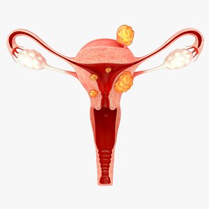 uterine fibroids 3D model
