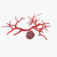 Tumor