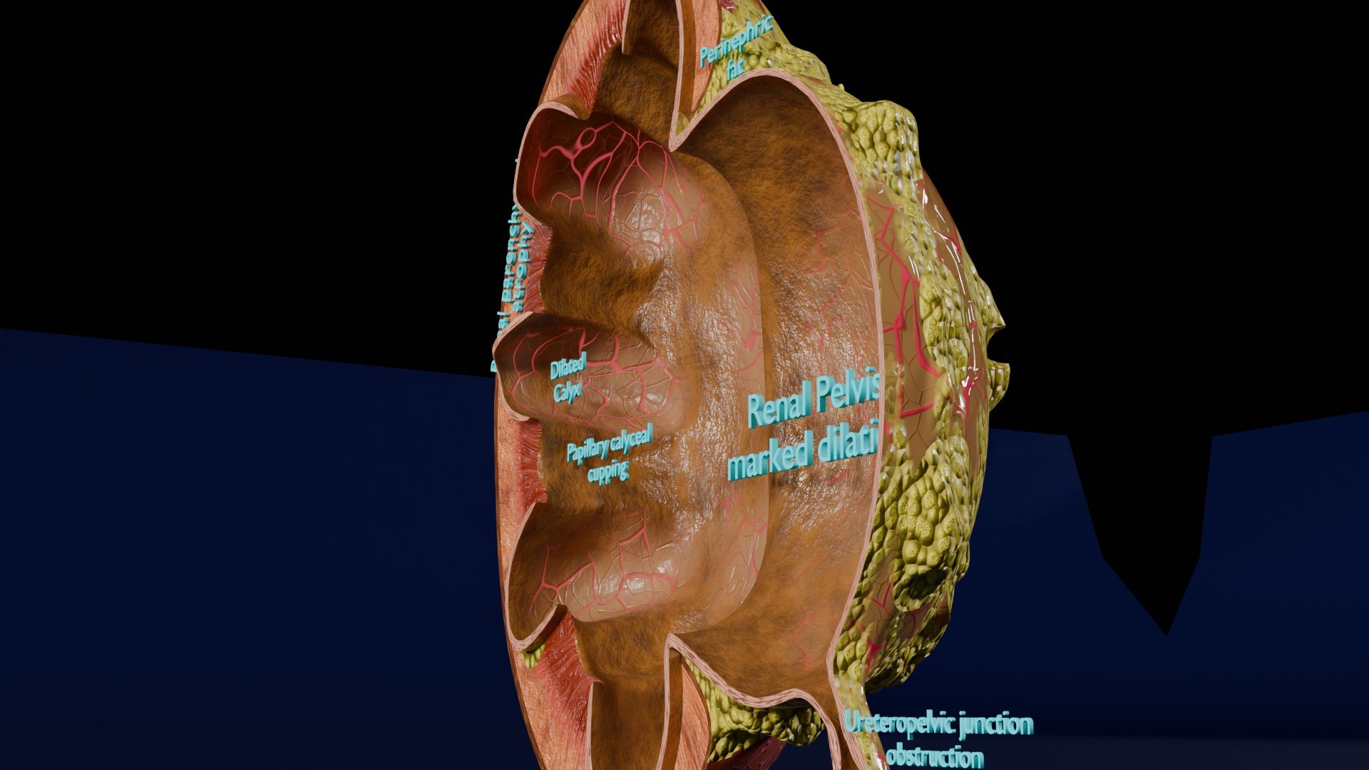 3D Hydronephrosis Marked Kidney Renal Model - TurboSquid 2320712