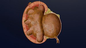 3D Hydronephrosis marked kidney renal model