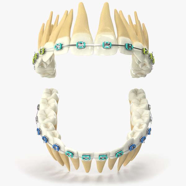 Human Teeth With Steel Dental Braces V04 model