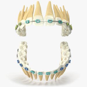 Human Teeth With Steel Dental Braces V04