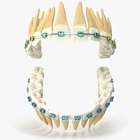 Human Teeth With Steel Dental Braces V04