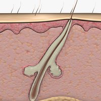 acne hair folicle (Animated)