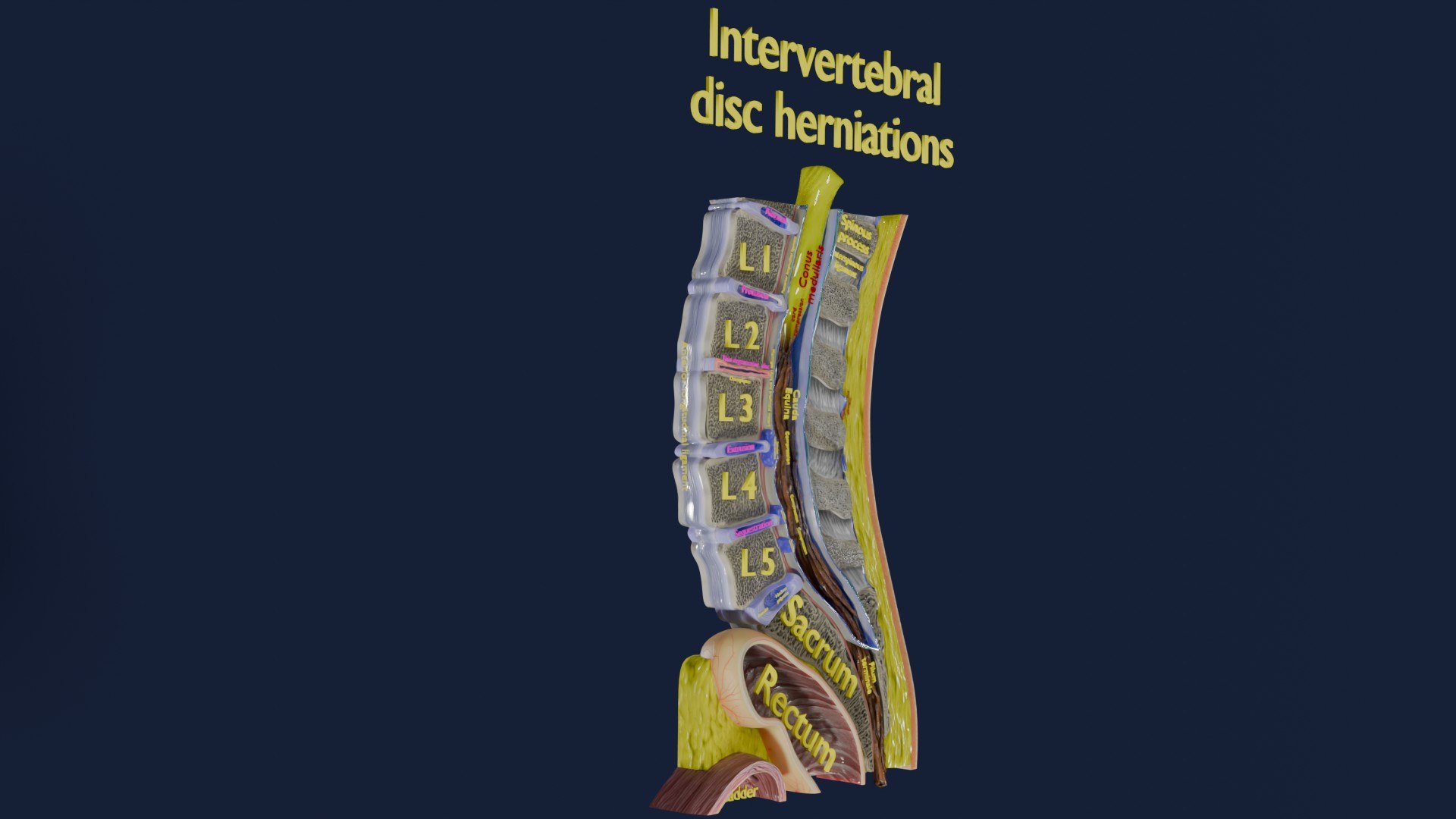 Intervertebral Herniation Slipped Ruptured Disc 3D - TurboSquid 2388428