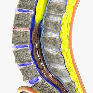 Intervertebral herniation slipped ruptured disc 3D