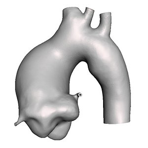 Ascending aortic aneurysm