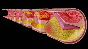 Artery Atherosclerosis plaque and consequences 3D model