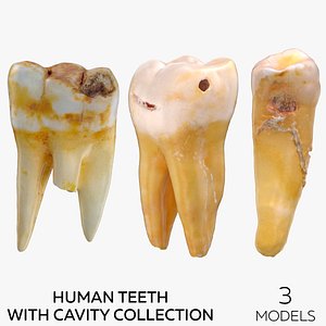 Human Teeth with Cavity Collection - 3 models 3D model
