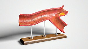 Atherosclerotic Vessel Vintage Plastic Model