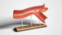 Atherosclerotic Vessel Vintage Plastic Model