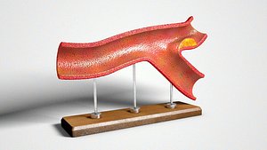 Atherosclerotic Vessel Vintage Plastic Model