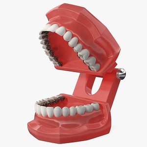 Lingual Braces on Typodont Teeth Model