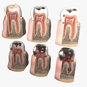 Caries Teeth severity schematic cut sectional 3D