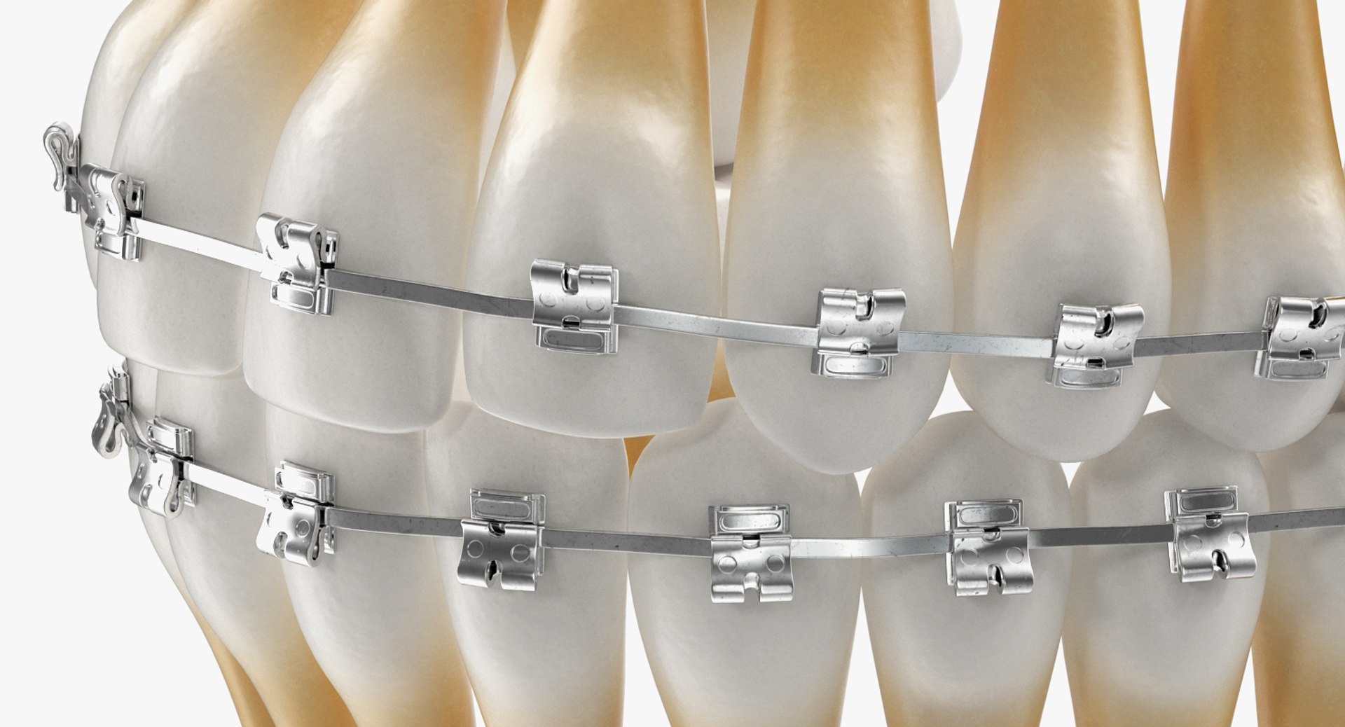 Teeth braces modeled model - TurboSquid 1289755