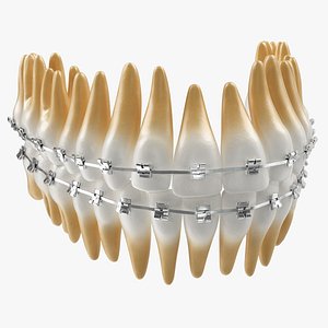 teeth braces modeled model